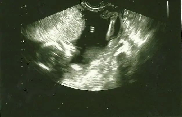 ultrasound image of a baby conceived via IVF at UNC fertility clinic