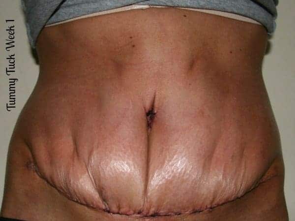 Week One Tummy Tuck Recovery Photo